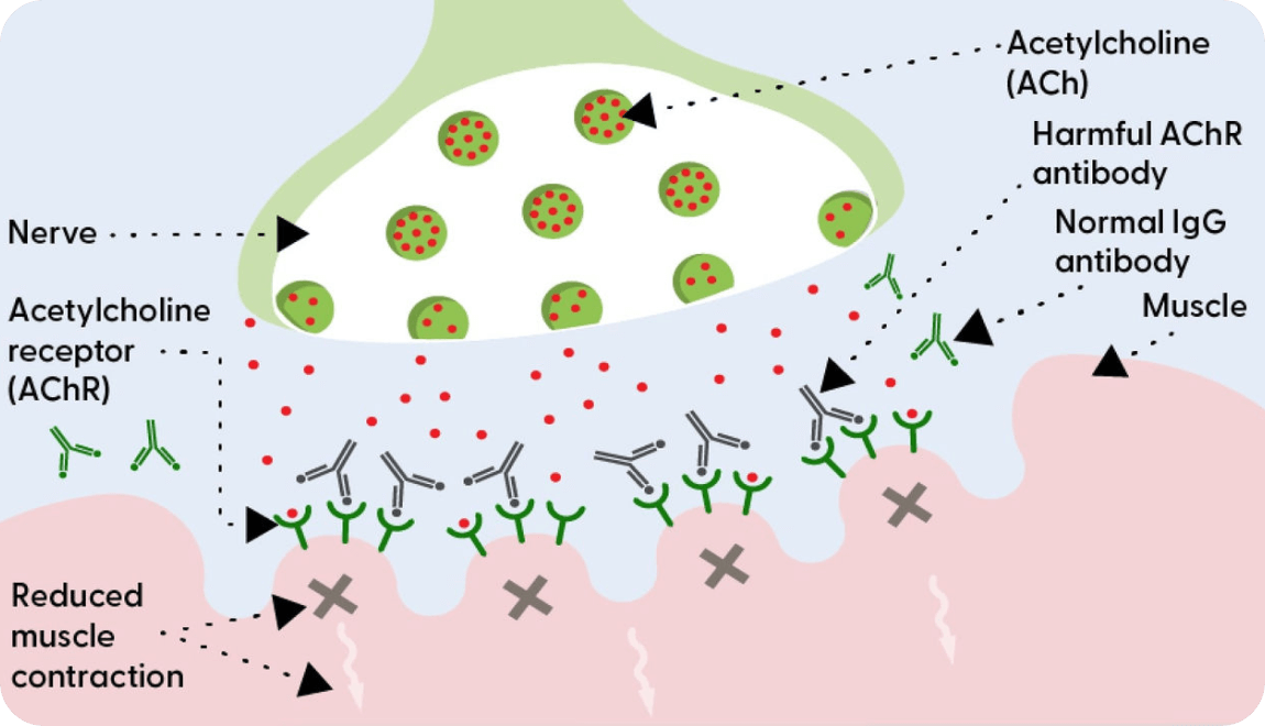 Diagram of a neuromuscular junction affected by Myasthenia Gravis