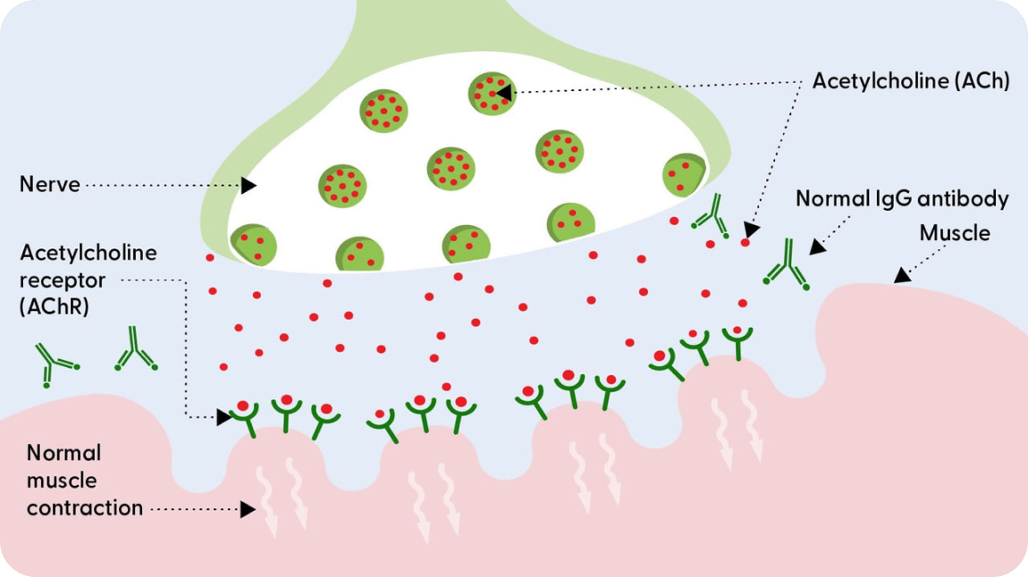 Diagram of a healthy neuromuscular junction without Myasthenia Gravis